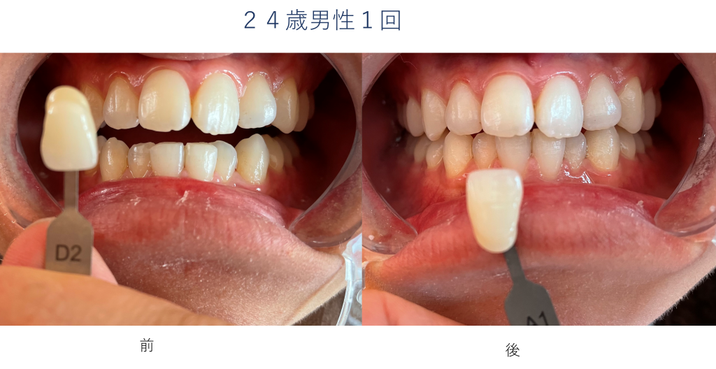 ビフォーアフター